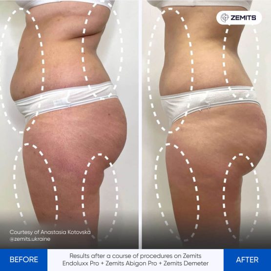 Zemits Abigon Pro Results 1