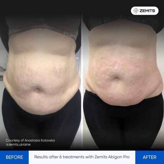 Zemits Abigon Pro Results 2