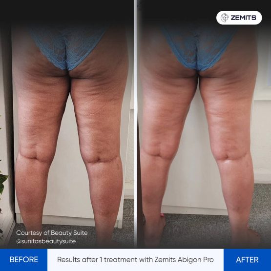 Zemits Abigon Pro Results 3