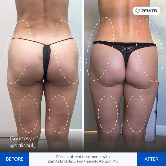 Zemits Abigon Pro Results 4