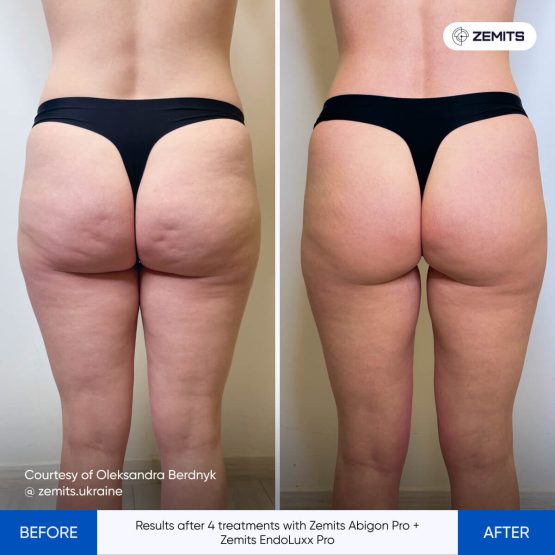 Zemits Abigon Pro Results 6