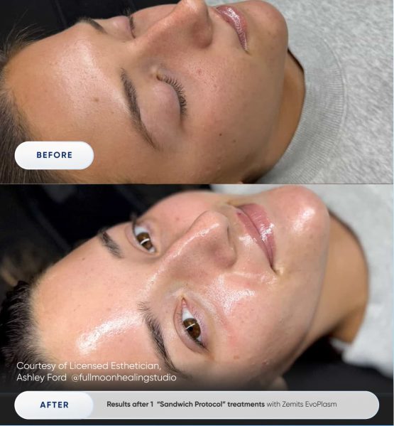 Zemits EvoPlasm Cold Plasma Technology Before After 01