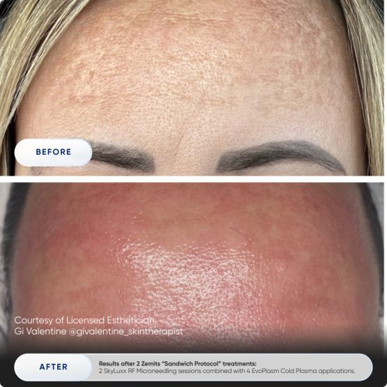 Zemits EvoPlasm Cold Plasma Technology Before After 02