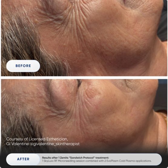 Zemits EvoPlasm Cold Plasma Technology Before After 03