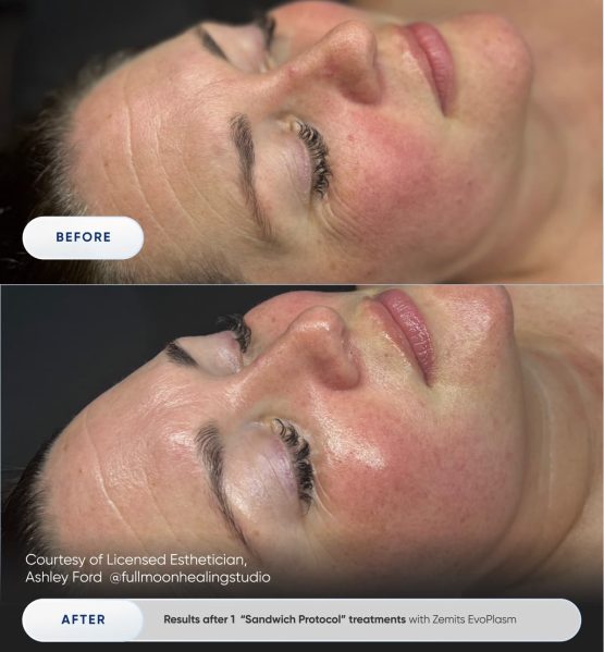 Zemits EvoPlasm Cold Plasma Technology Before After 04
