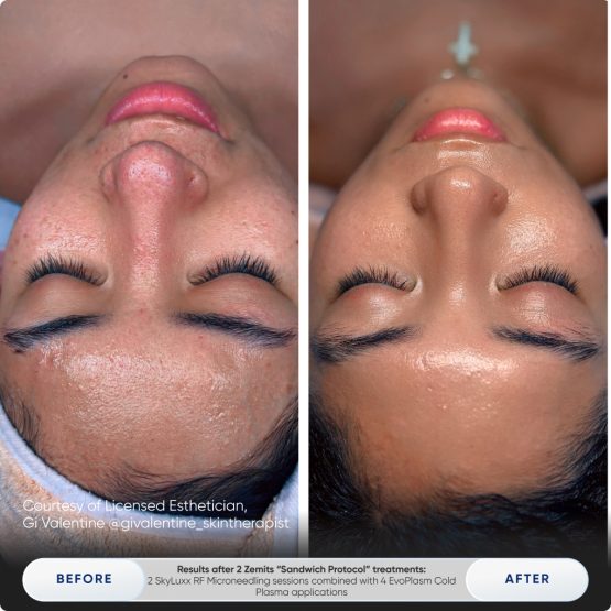 Zemits EvoPlasm Cold Plasma Technology Before After 05