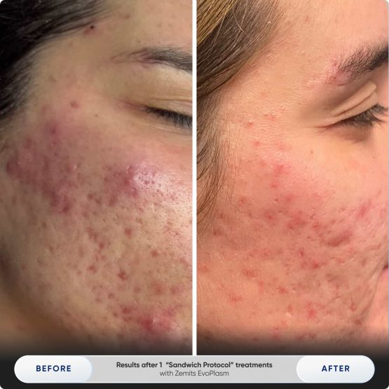 Zemits EvoPlasm Cold Plasma Technology Before After 06