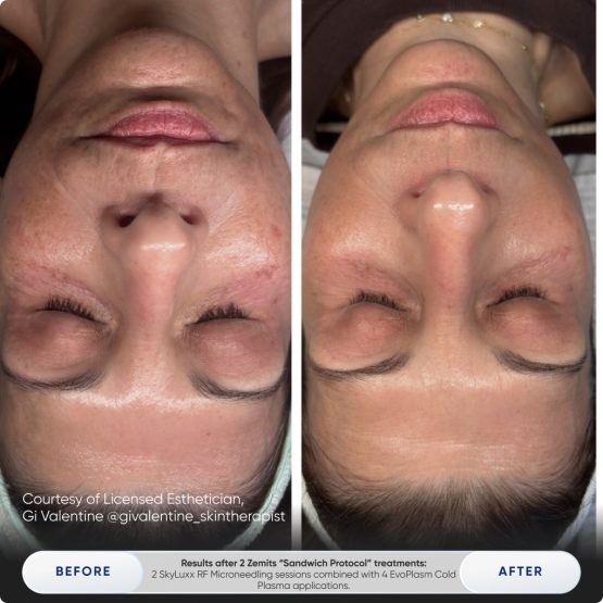 Zemits EvoPlasm Cold Plasma Technology Before After 07